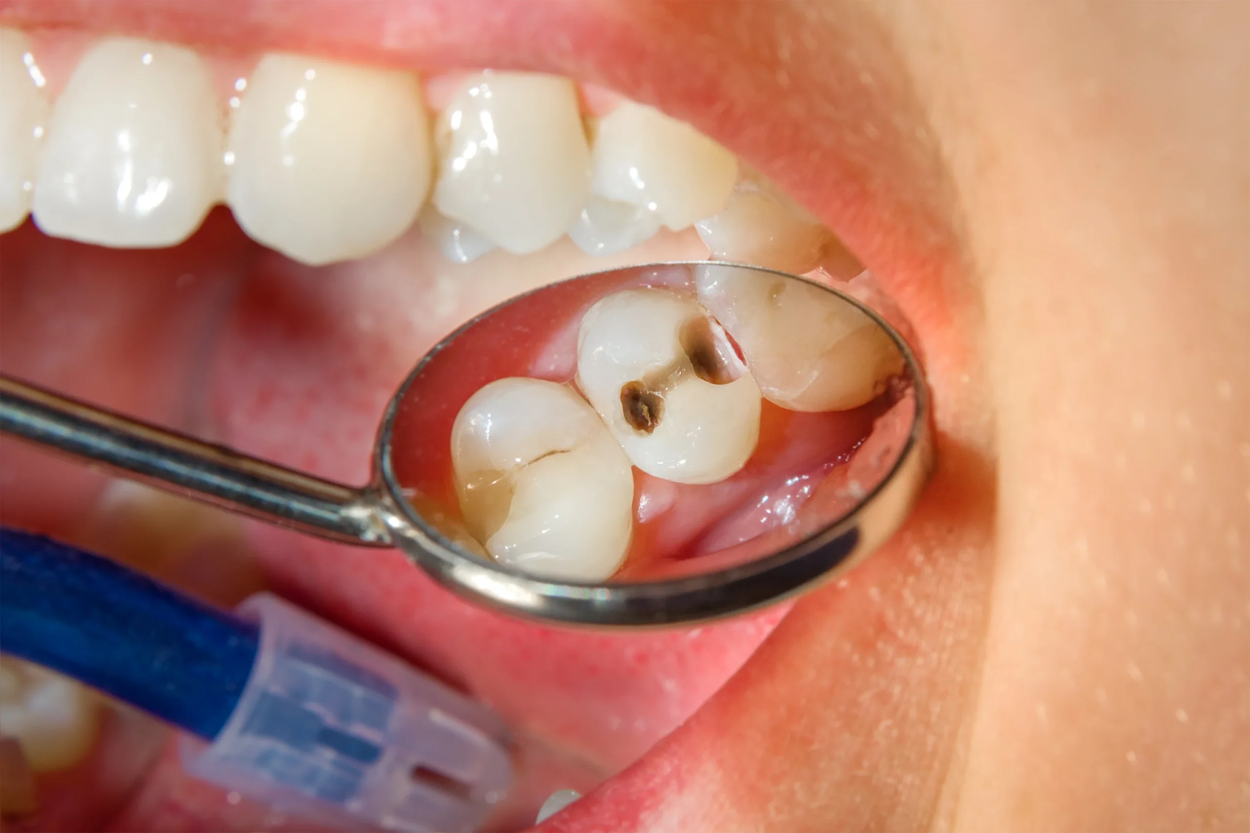 Best Cavity Treatment in Delhi