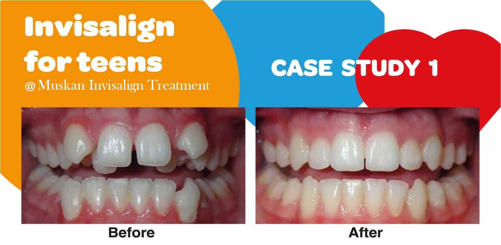 INVISALIGN-TEEN-CASE-STUDY
