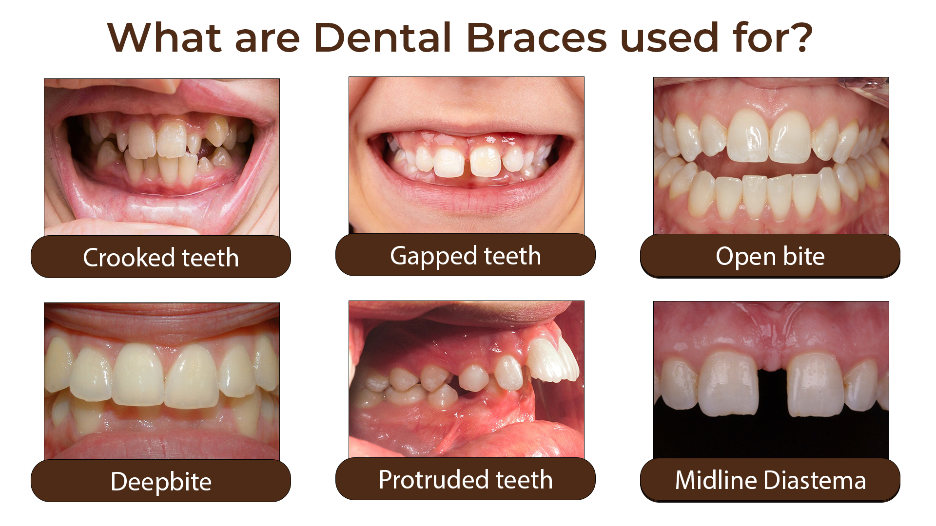 Uses-Of-Dental-Braces