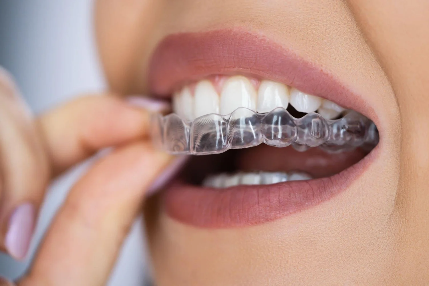 Invisalign Treatment in Delhi