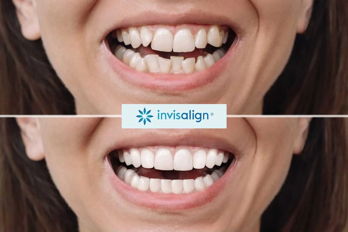 invisalign-before-and-after