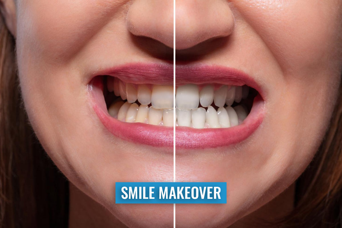 Smile Makeovers in Delhi Ncr