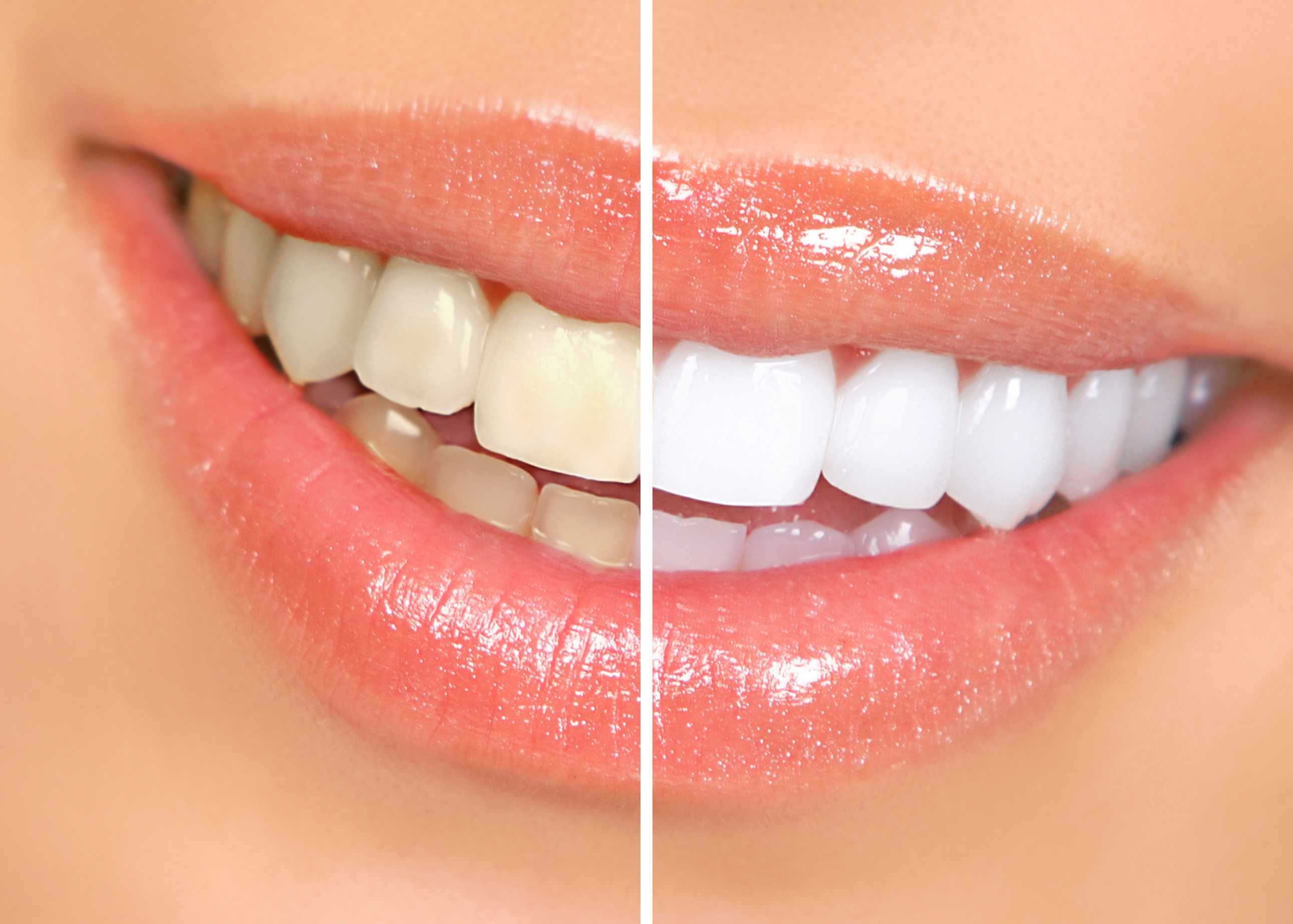teeth whitening in Delhi